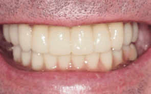 Dental Implants london