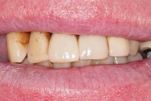 Dental Implants London