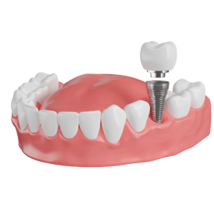 Dental implants london