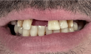 Dental Implants london