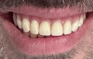 Dental Implants London