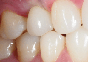 Dental implants london