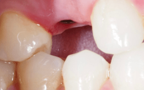 Dental Implants london