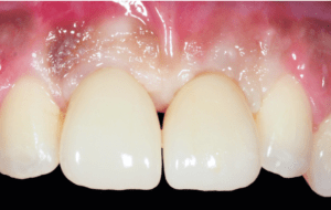 Dental Implants London