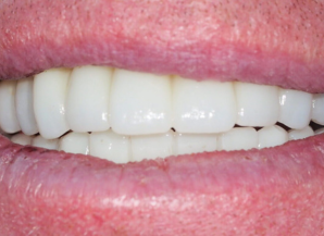 Dental Implants London