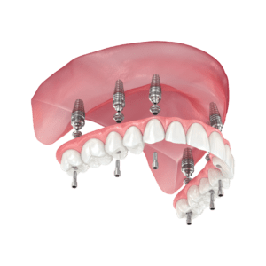 All on 4 dental implants london