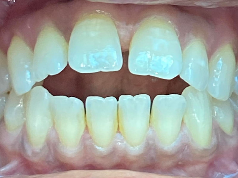 Before Invisalign
