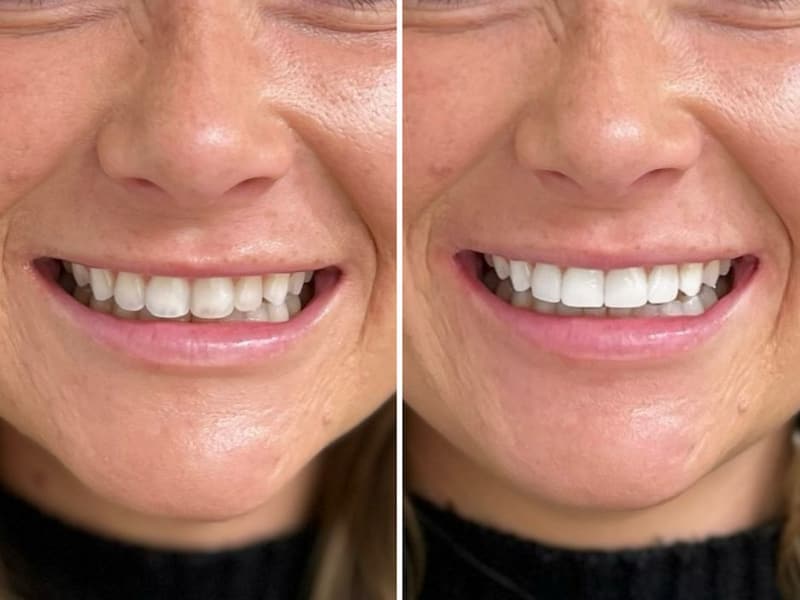 Composite bonding result, Blue Pearl Dental Care