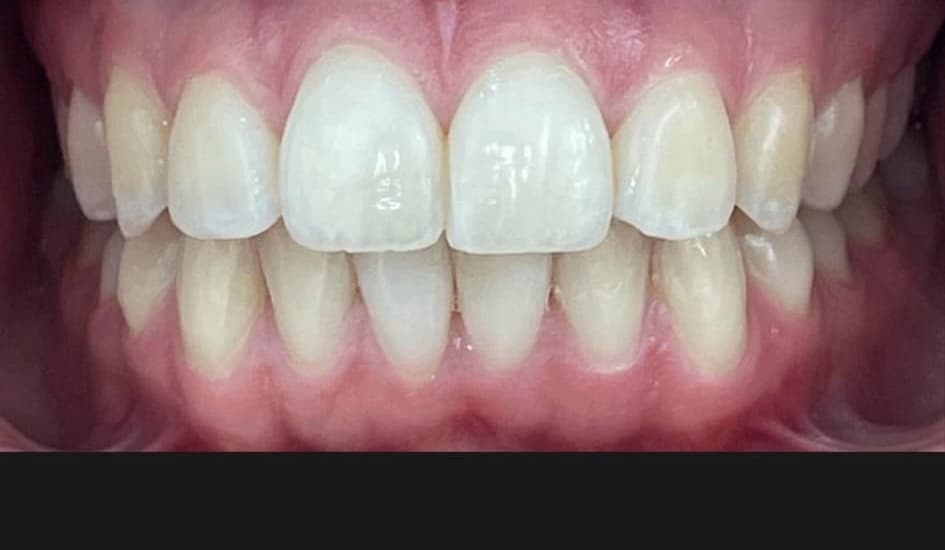 Invisalign patient after treatment at Blue Pearl Dental Care