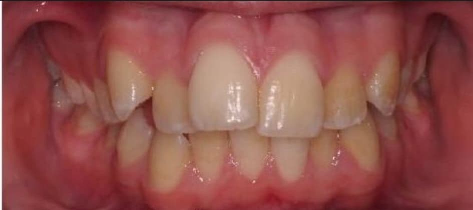 Invisalign patient before treatment at Blue Pearl Dental Care