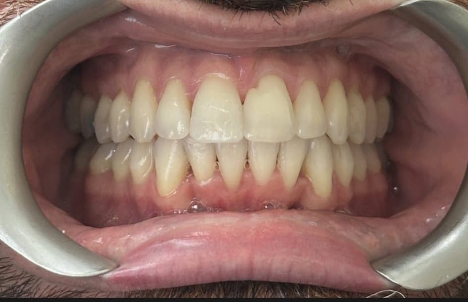 Invisalign patient after treatment at Blue Pearl Dental Care