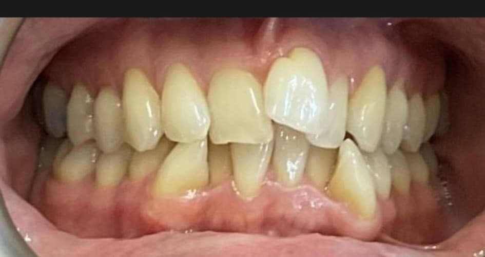 Invisalign patient before treatment at Blue Pearl Dental Care