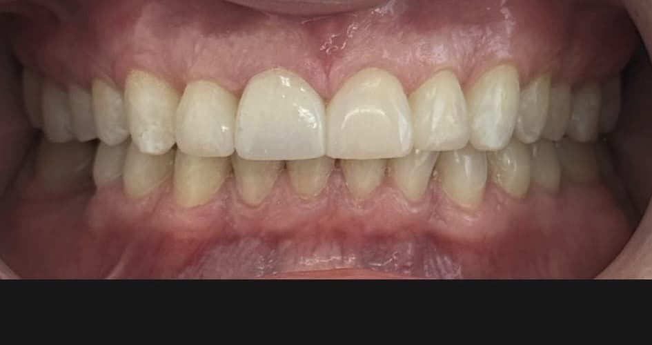 Invisalign patient after treatment at Blue Pearl Dental Care