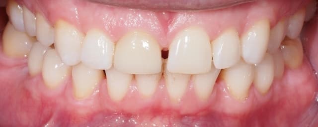 Invisalign patient before treatment at Blue Pearl Dental Care
