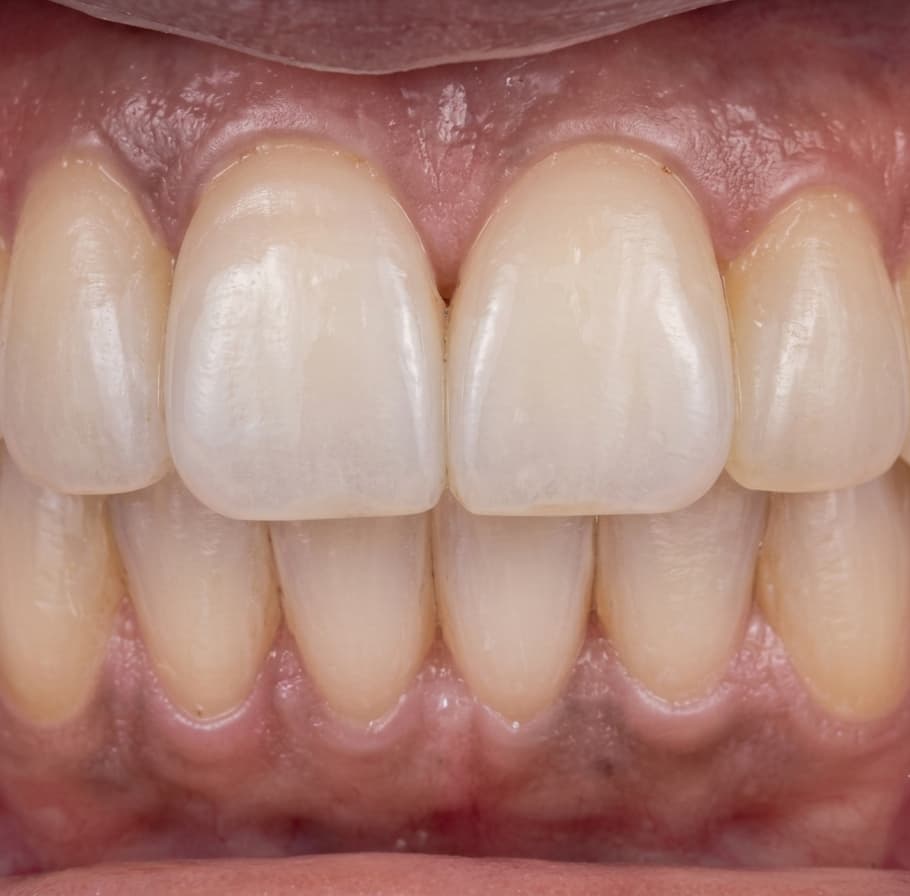 Ortodoncia e Invisalign, resultado despu&eacute;s del tratamiento