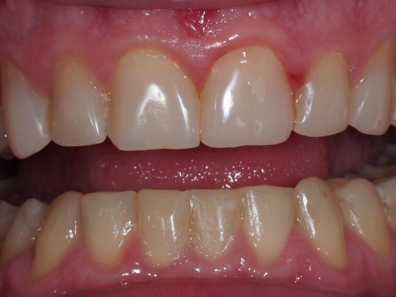 After smile design with porcelain veneers
