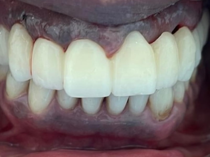 After All-on-4 implants, full arch restoration