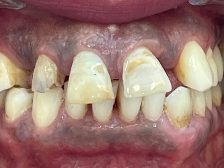 Before All-on-4 implants