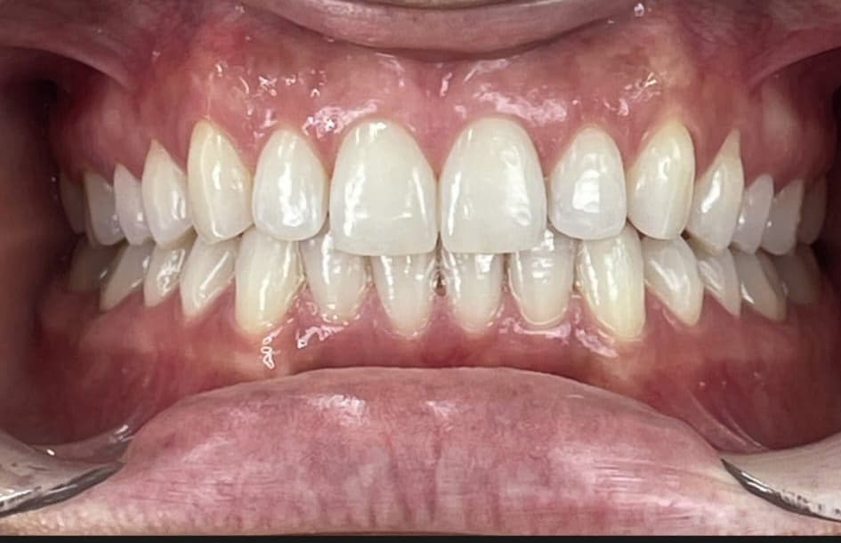 Invisalign patient after treatment at Blue Pearl Dental Care