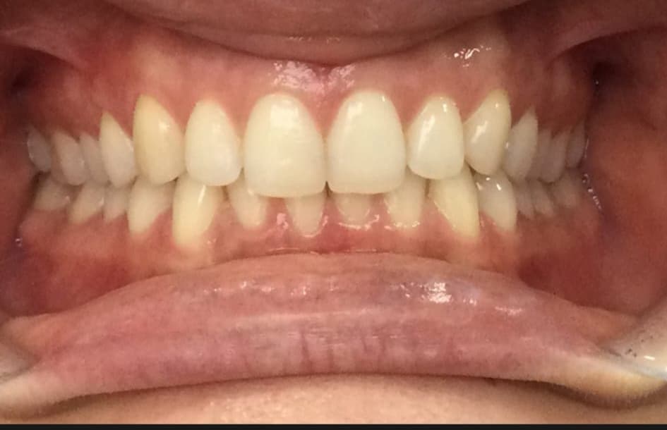 Invisalign patient before treatment at Blue Pearl Dental Care