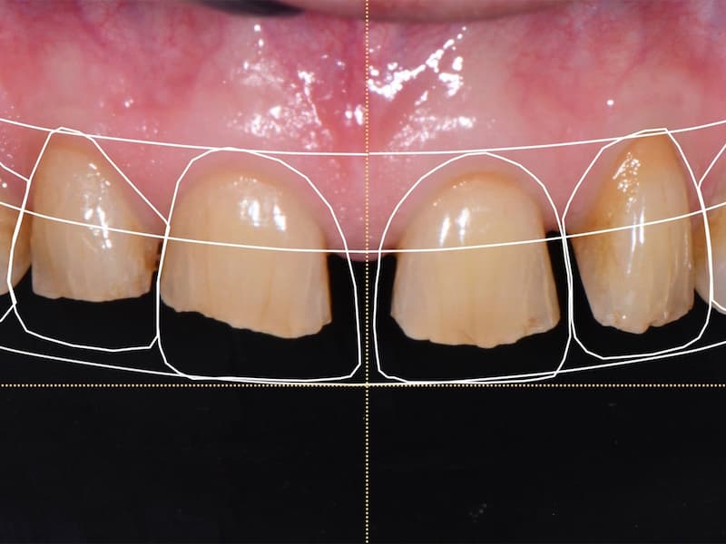 Smile design with porcelain veneers at Blue Pearl Dental Care