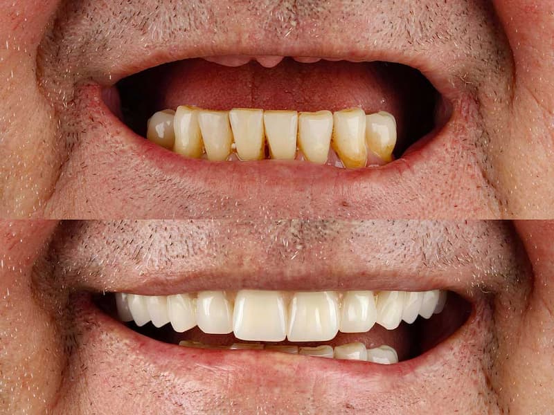 All-on-4 dental implants at Blue Pearl Dental Care