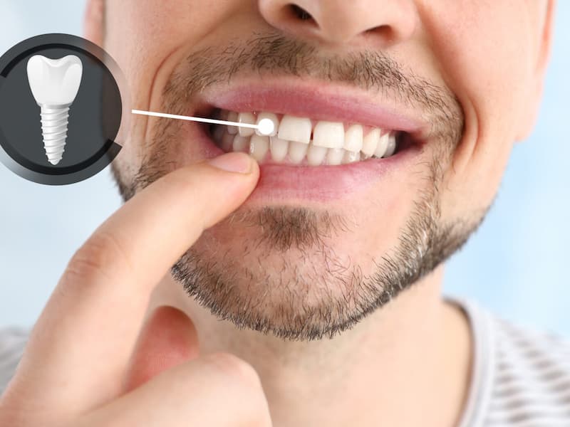 Dental implant treatment at Blue Pearl Dental Care